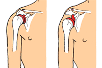 Schulterluxation